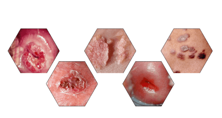 Защо папиломите са опасни