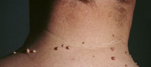 как да се отървете от папиломите