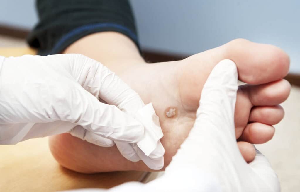 защо се появяват брадавици по тялото