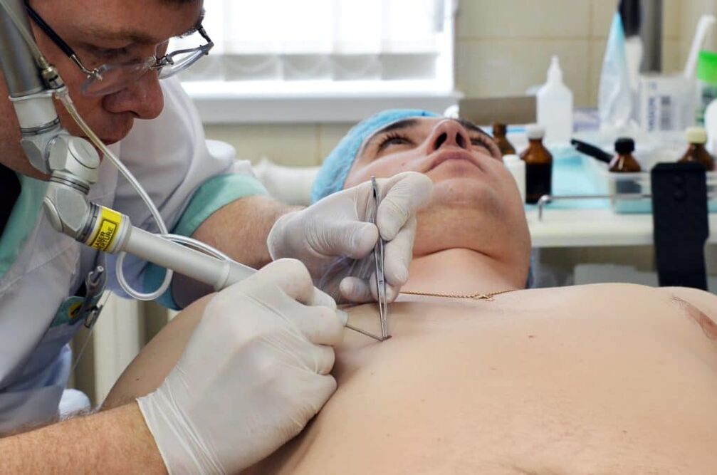 как да се отървете от брадавици по тялото