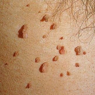 Папиломите често растат в колонии и могат да се появят по кожата на цялото тяло